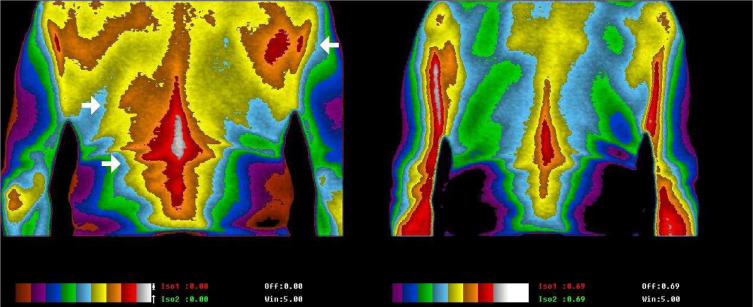 Earthing sheet & grounding mat usage after four nights and body scans on inflammation improvement.